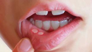 أعراض في الفم تحذر من نقص شديد في فيتامين ب 12